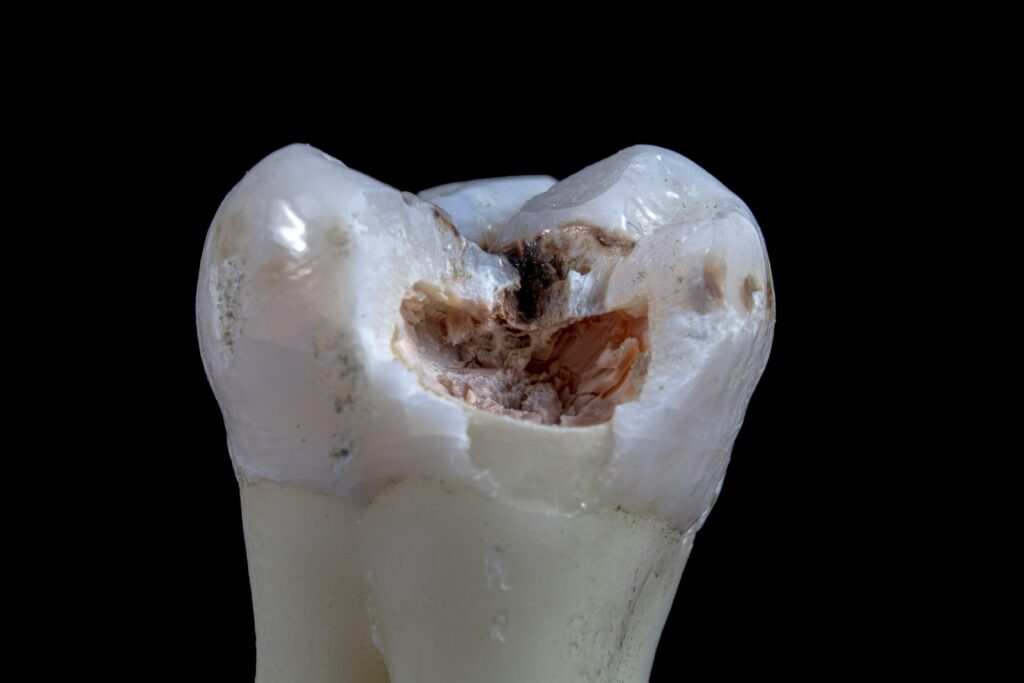 tooth decay tooth with decay