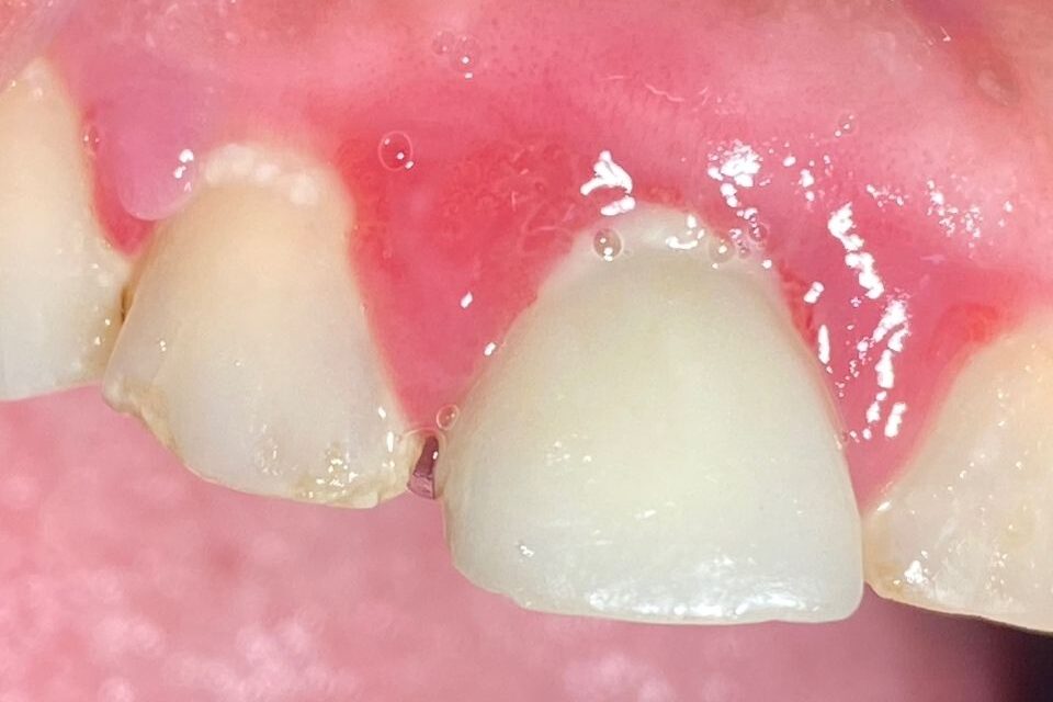 Image of swollen and reddened gums