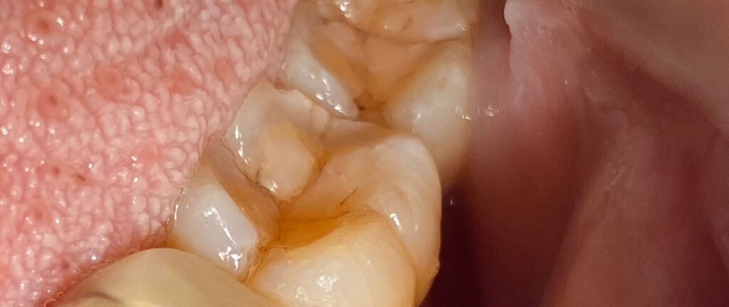 A cracked molar tooth An image of the molar tooth with a crack