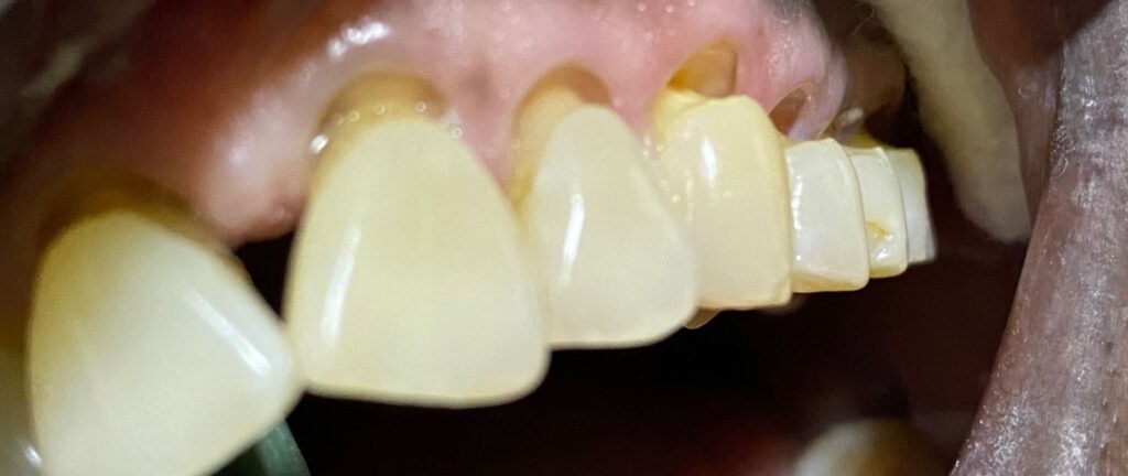 cervical abrasions of the teeth An image of the teeth showing cervical abrasions