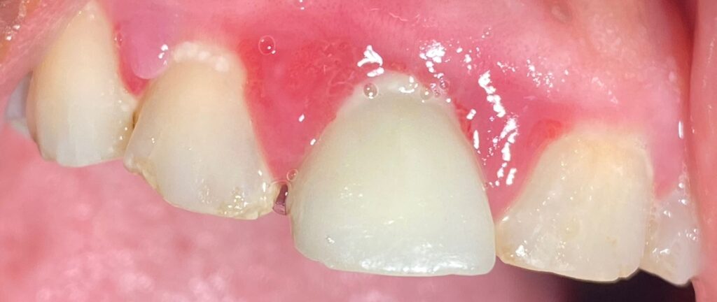 An image showing infected gums